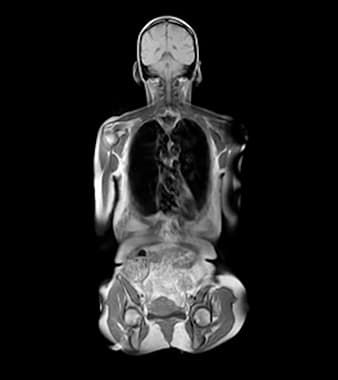 Full-Body MRI